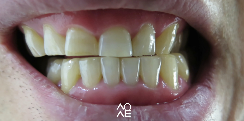 찬물 이시림 잇몸패임 원인 2가지, 치료법 관련 이미지 4