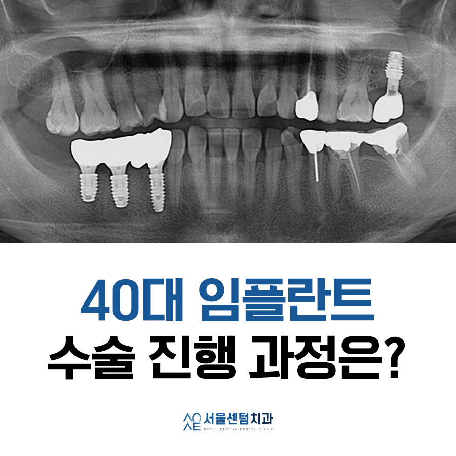 40대임플란트 수술 어떻게 하나요? 관련 이미지 6