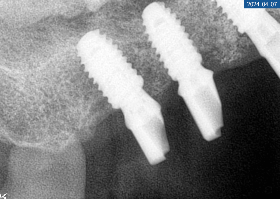 임플란트 브릿지와 크라운 수복으로 치아 기능을 회복시킨 증례 관련 이미지 18