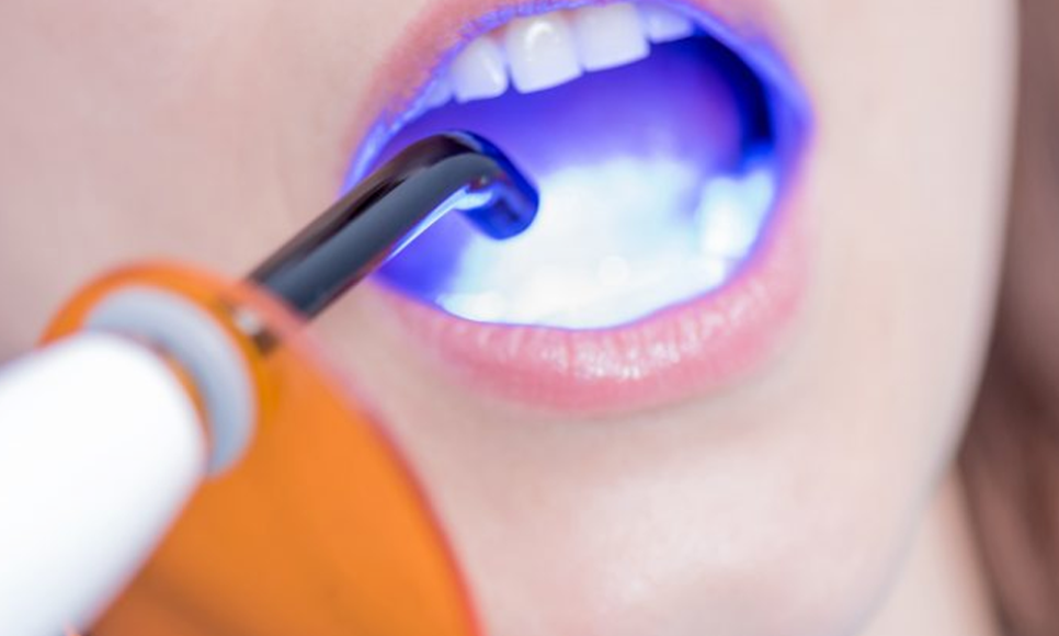 치과 앞니 사이 레진, 당일 진료 가능 관련 이미지 7