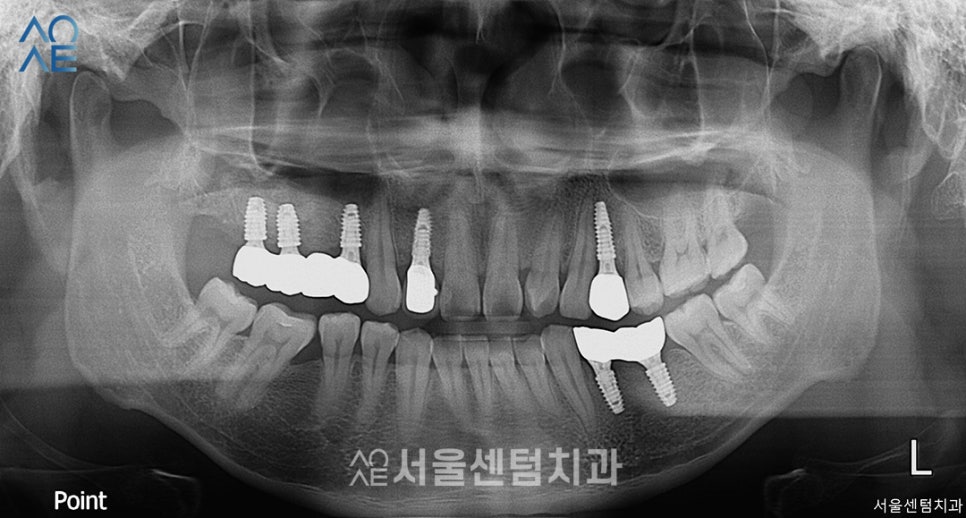 임플란트 과정 기간 실제 사례로 설명드려요 관련 이미지 6