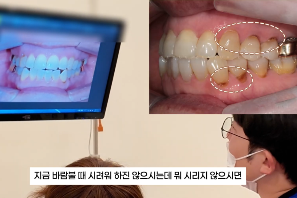 치아패임 이대로 두어도 괜찮을까요 치경부마모증 레진치료 관련 이미지 9