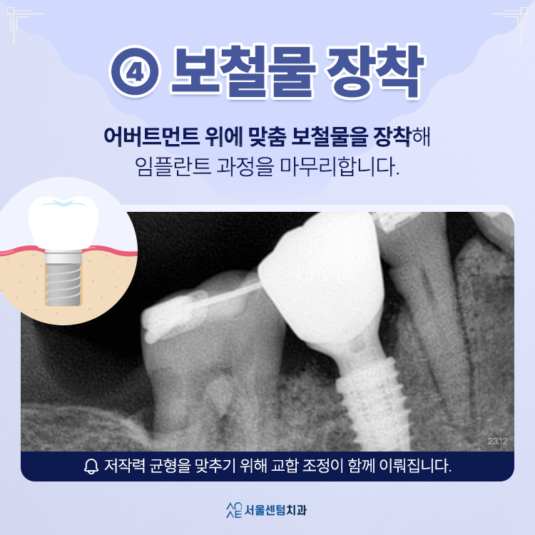 임플란트 할 때의 절차 과정은 대체로 이렇게 진행돼요 관련 이미지 5