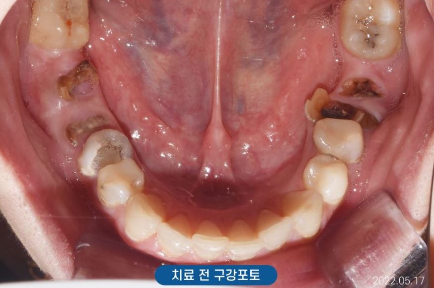 신사역주말치과 갑자기 어금니 이빨 부러졌다면 관련 이미지 5