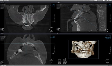 신사동치과 임플란트 끝난 후 절대 잊지 말아야 할 주의사항 관련 이미지 8