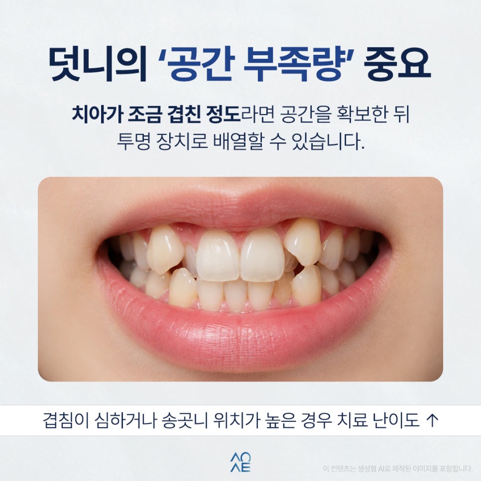 투명교정 비용 얼마나 들죠? 덧니와 부정교합도 가능한지 알고 싶어요 관련 이미지 2