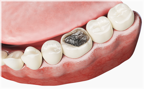 만65세 임플란트 지원 혜택 통해서 가격 부담 줄이세요 관련 이미지 4