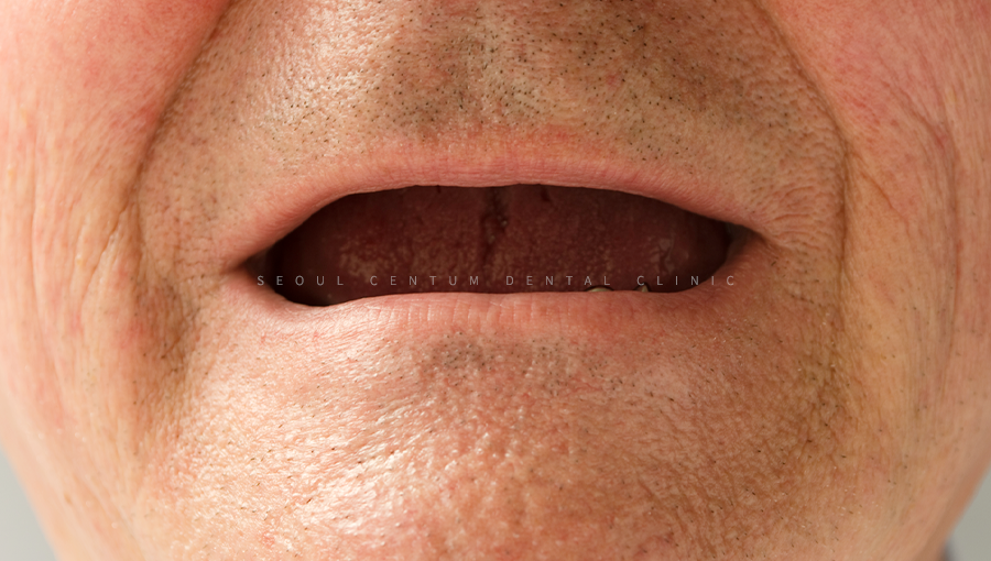 상악 전체임플란트 혹시 나도 대상자일까? 관련 이미지 2