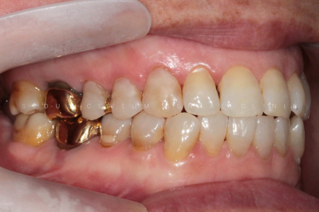 치아패임 이대로 두어도 괜찮을까요 치경부마모증 레진치료 관련 이미지 2