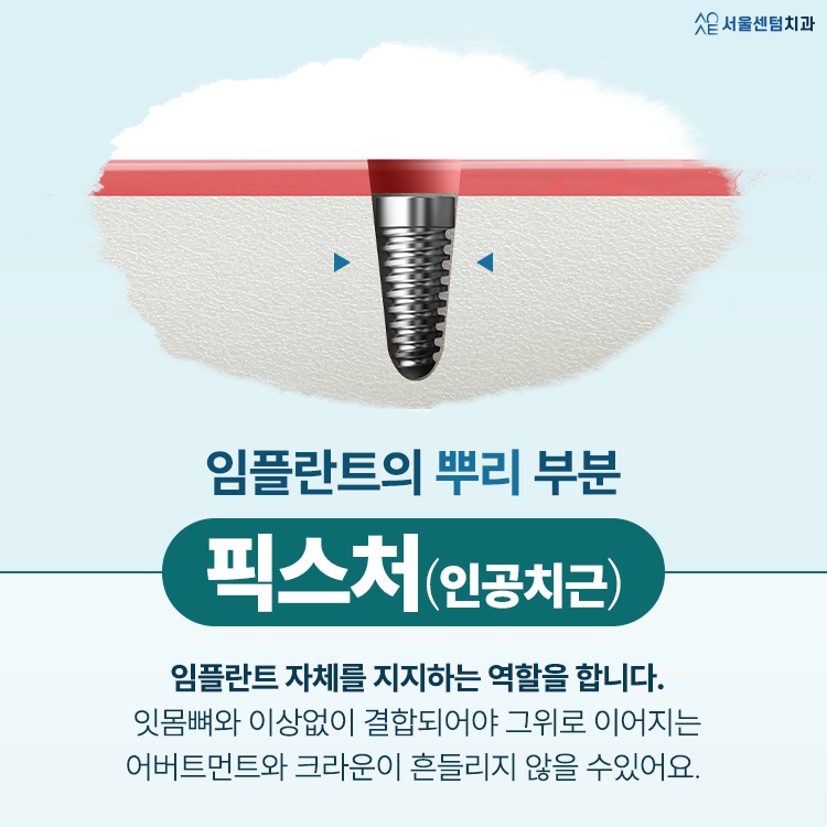 임플란트 구조 하나하나 뜯어보면 알 수 있는 원리 관련 이미지 3