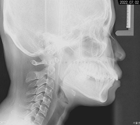 돌출입 및 신경치료와 임플란트 식립 동시 진행 증례 관련 이미지 5