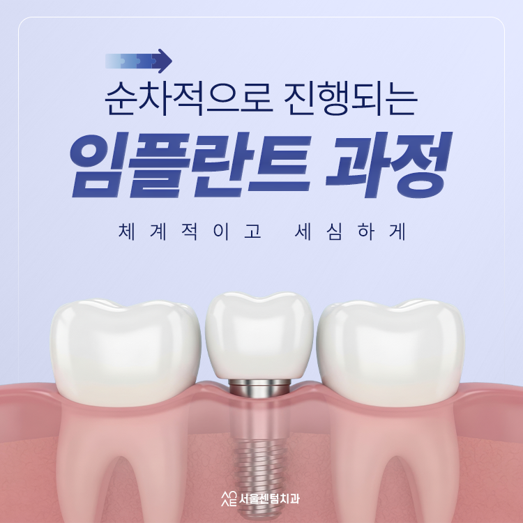임플란트 할 때의 절차 과정은 대체로 이렇게 진행돼요 관련 이미지 1
