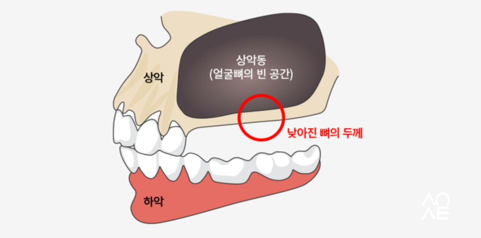 국민 건강보험 임플란트 노인 무치악의 기준은? 관련 이미지 9