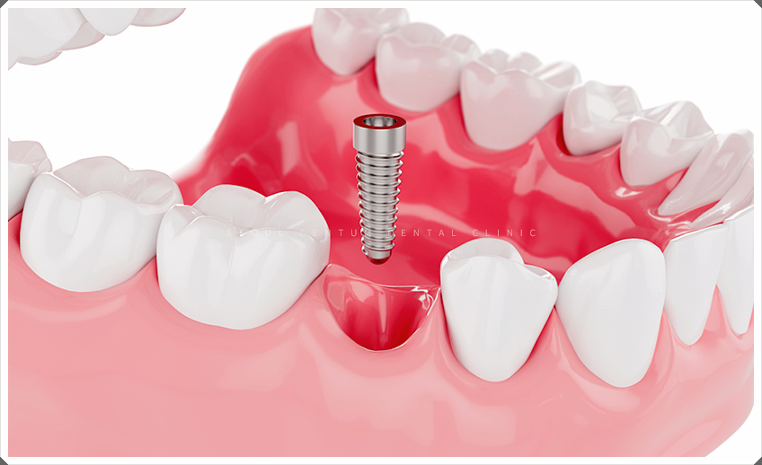 치아 뼈이식 비용 얼마로 산정될까? 관련 이미지 2