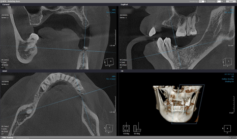 임플란트 브릿지와 크라운 수복으로 치아 기능을 회복시킨 증례 관련 이미지 6