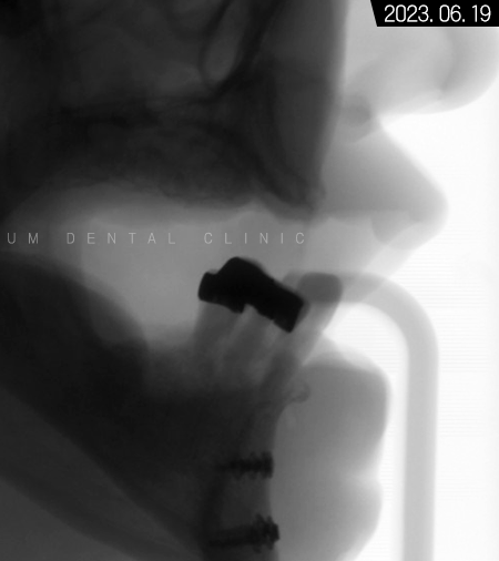 전체임플란트 기간 예상보다 줄어들 수 있는 방법과 증례 공개 관련 이미지 3