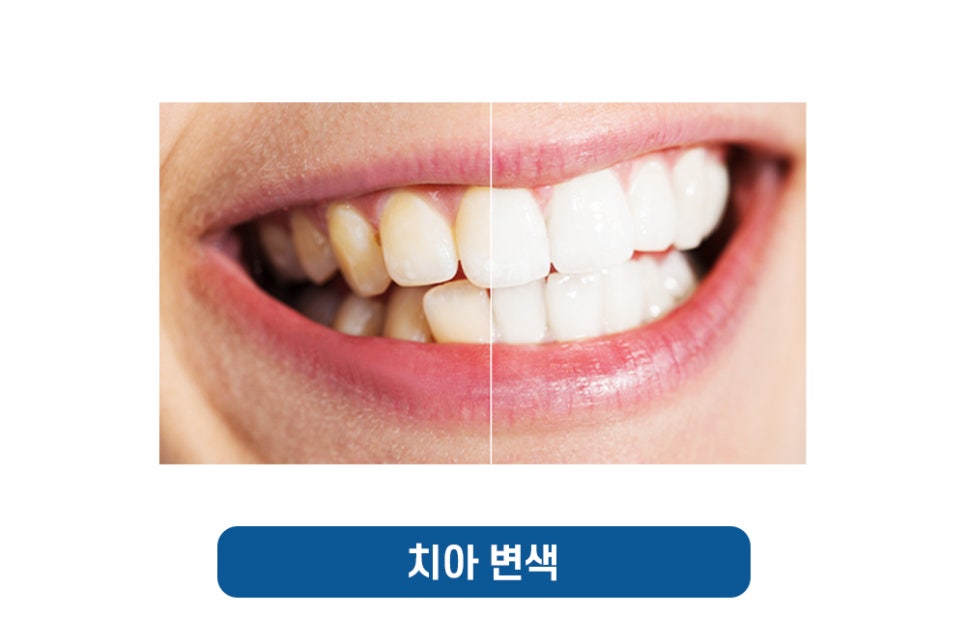 사랑니 발치 가글로 헥사메딘 써도 될까? 관련 이미지 6