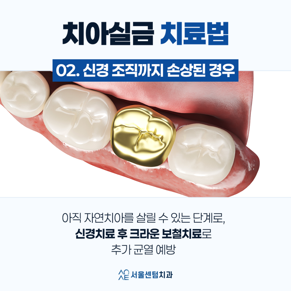 치아실금 신경쓰인다면 이것 체크하세요 관련 이미지 5