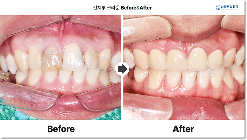 충치신경치료 종류 모조리 알려드릴게요. 관련 이미지 11