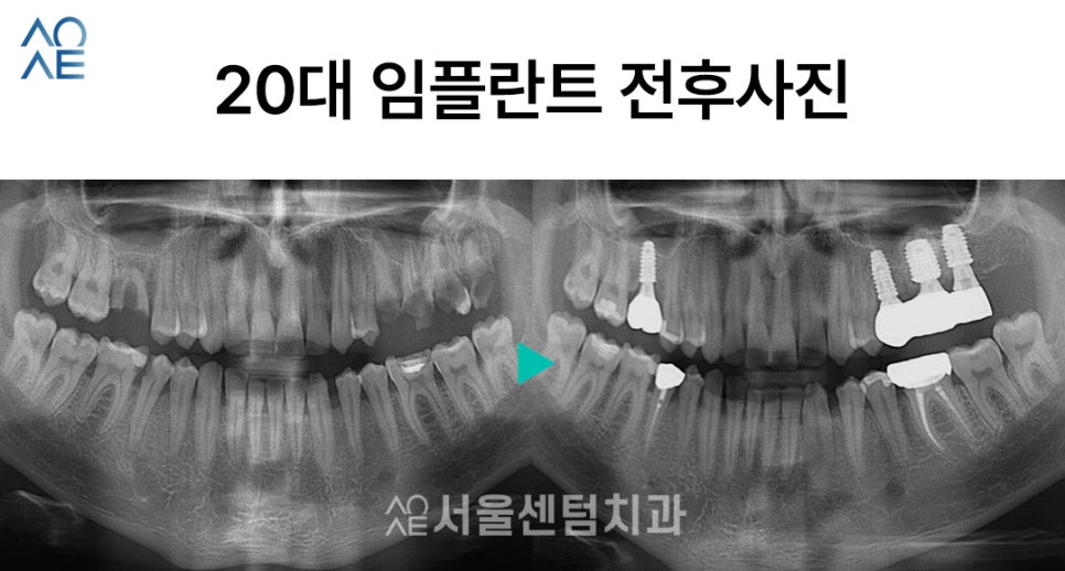 20대임플란트후기 진행과정부터 상세히 관련 이미지 6
