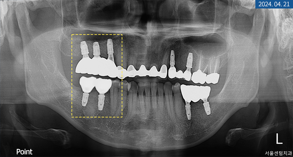 임플란트 브릿지와 크라운 수복으로 치아 기능을 회복시킨 증례 관련 이미지 19