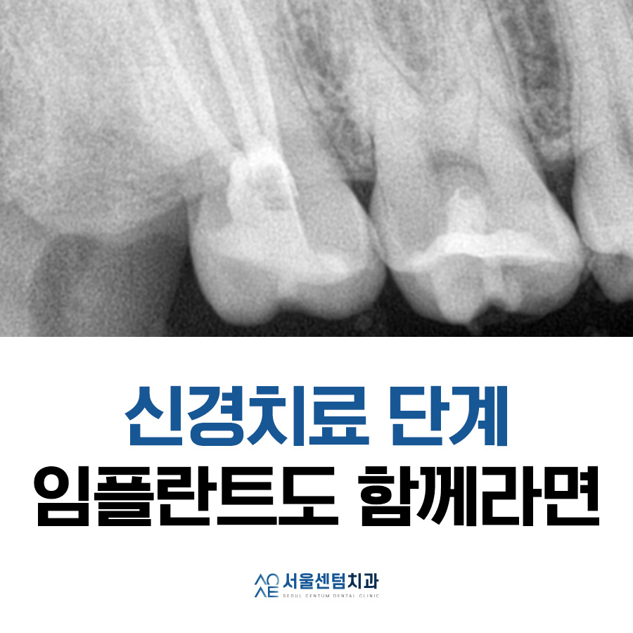 치아 신경치료 단계 임플란트까지 고려한다면 관련 이미지 7