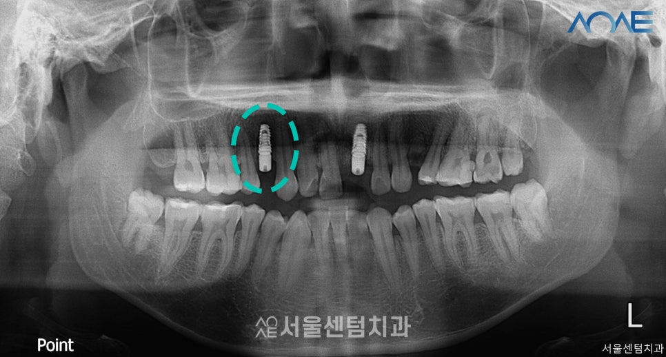 당일임플란트 상담부터 풀과정 공개 관련 이미지 7