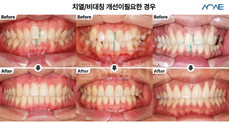 치아중심선교정 다양한 실제사례 보여드려요 관련 이미지 5