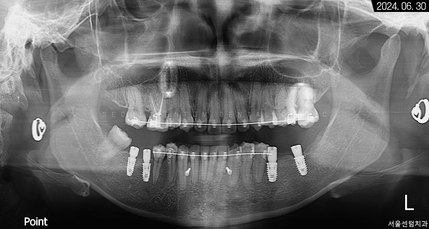 돌출입 및 신경치료와 임플란트 식립 동시 진행 증례 관련 이미지 20