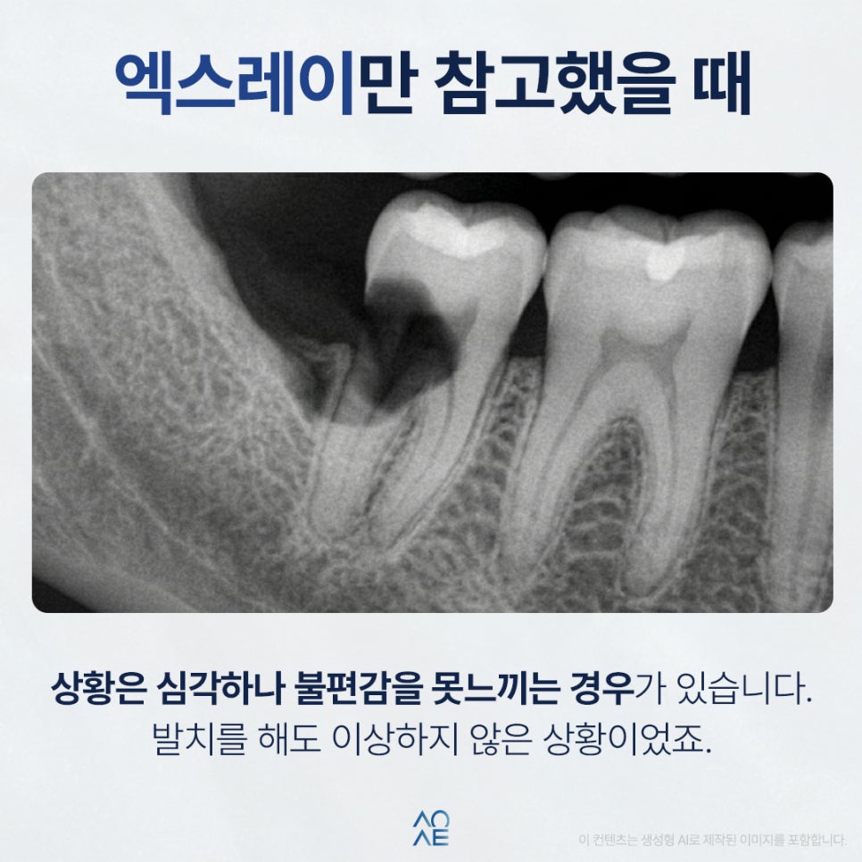 치과에서 사랑니발치 후 신경치료랑 크라운 하라고 하는데 진짜 꼭 해야할까요? 관련 이미지 3
