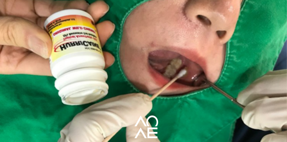 치과 마취 종류 풀리는 시간 주의사항에 대해서 관련 이미지 2