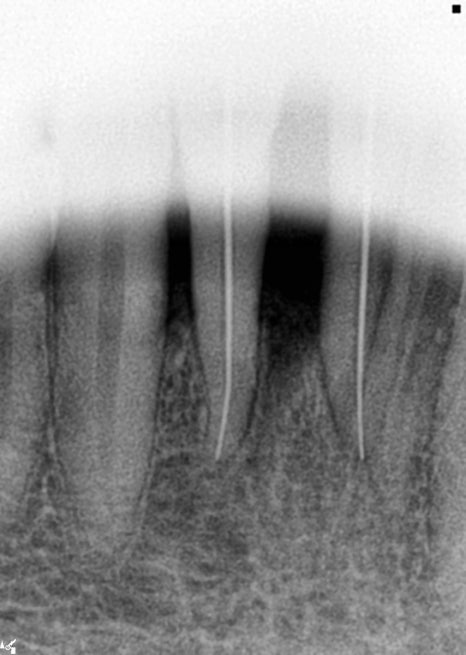 임플란트 순서 어금니부터 앞니부터 어디부터 해야할까요 관련 이미지 7