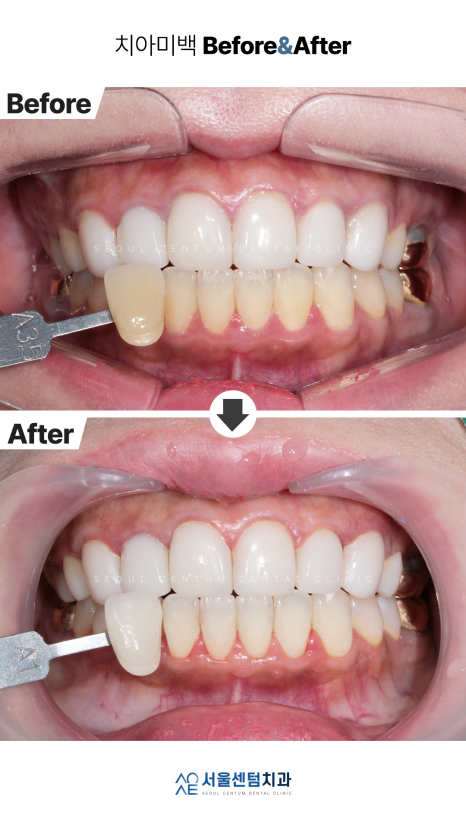 치과치아미백 전후 사진과 종류 소개 관련 이미지 5