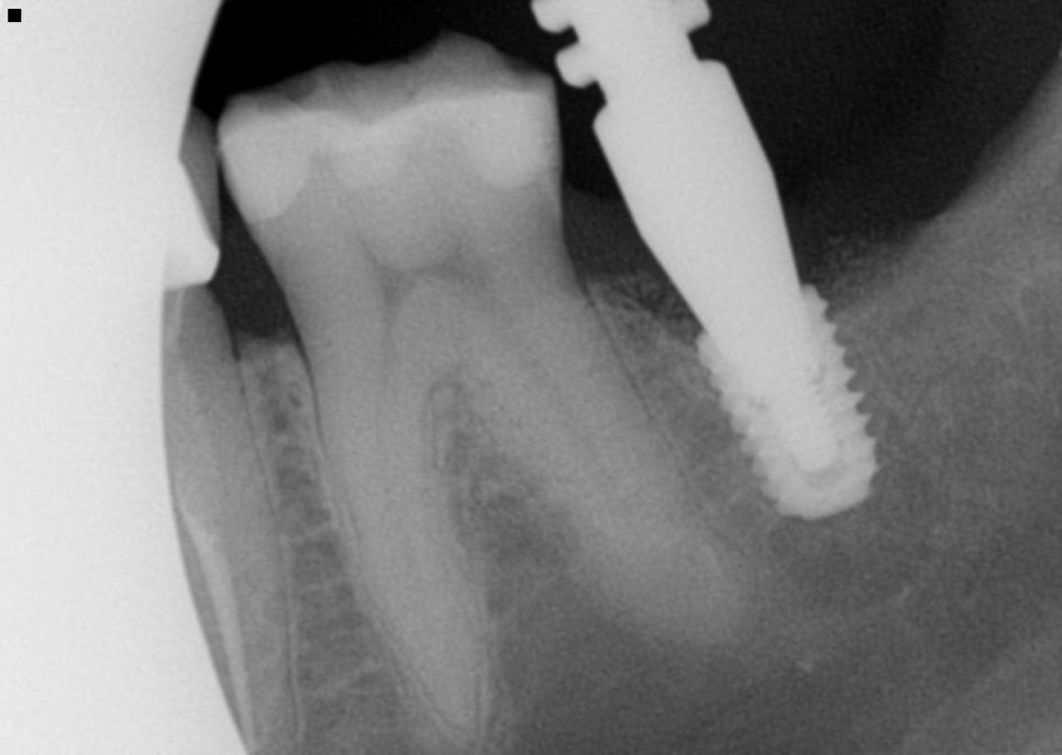 신사역치과 발치후 임플란트 시술과정 30대 남성 케이스 관련 이미지 9