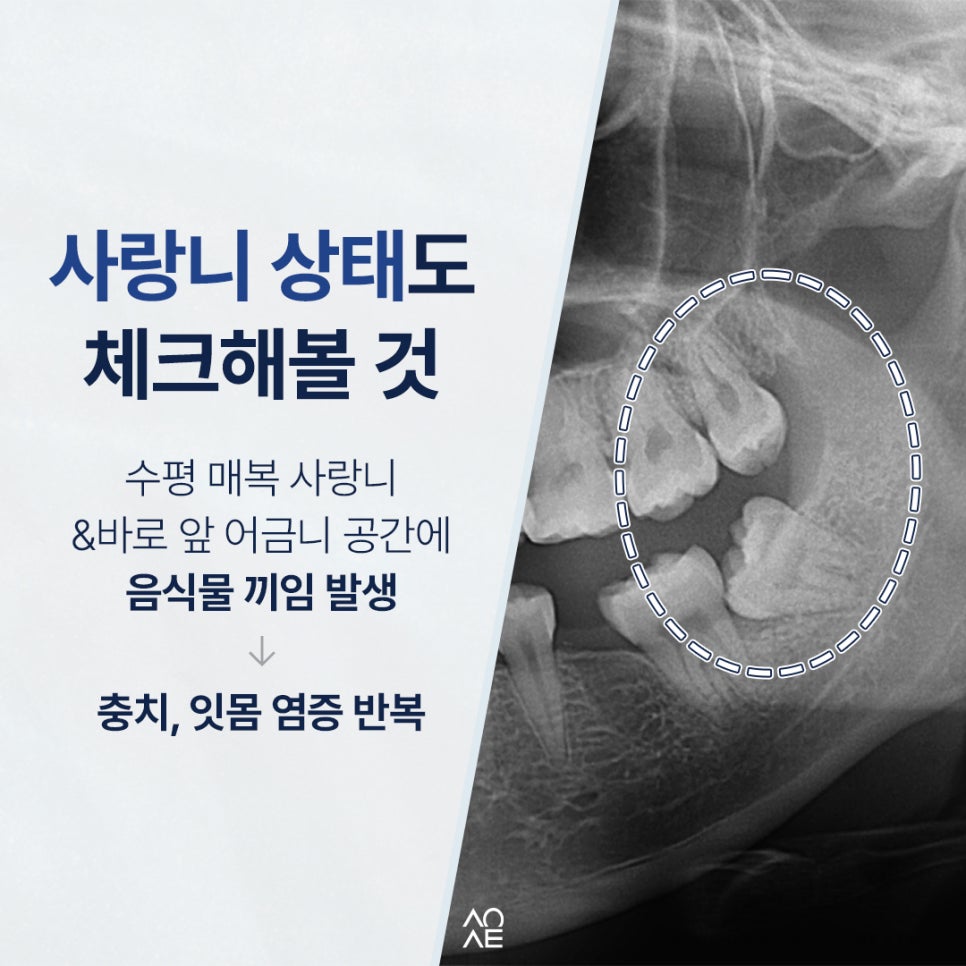 Do You Need Dental Implants in Your 30s? Is It Difficult to Save the Tooth? image 6