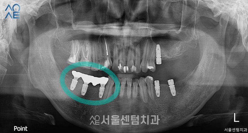 30대임플란트 치아상태 좋지 않아도 안심 관련 이미지 5