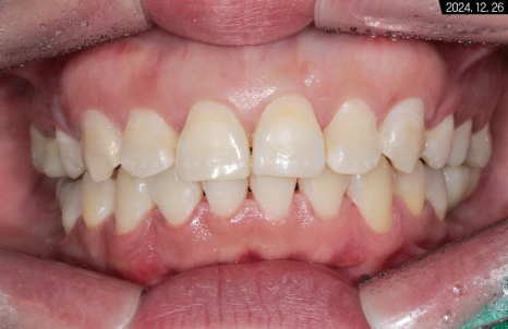 돌출입 및 신경치료와 임플란트 식립 동시 진행 증례 관련 이미지 26