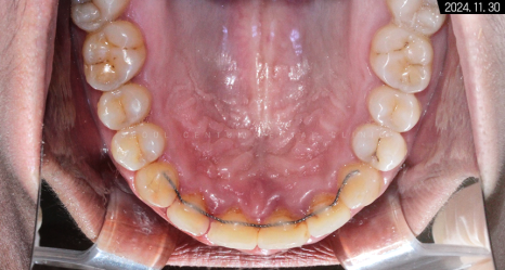 비발치로 돌출입 해소한 증례 관련 이미지 16