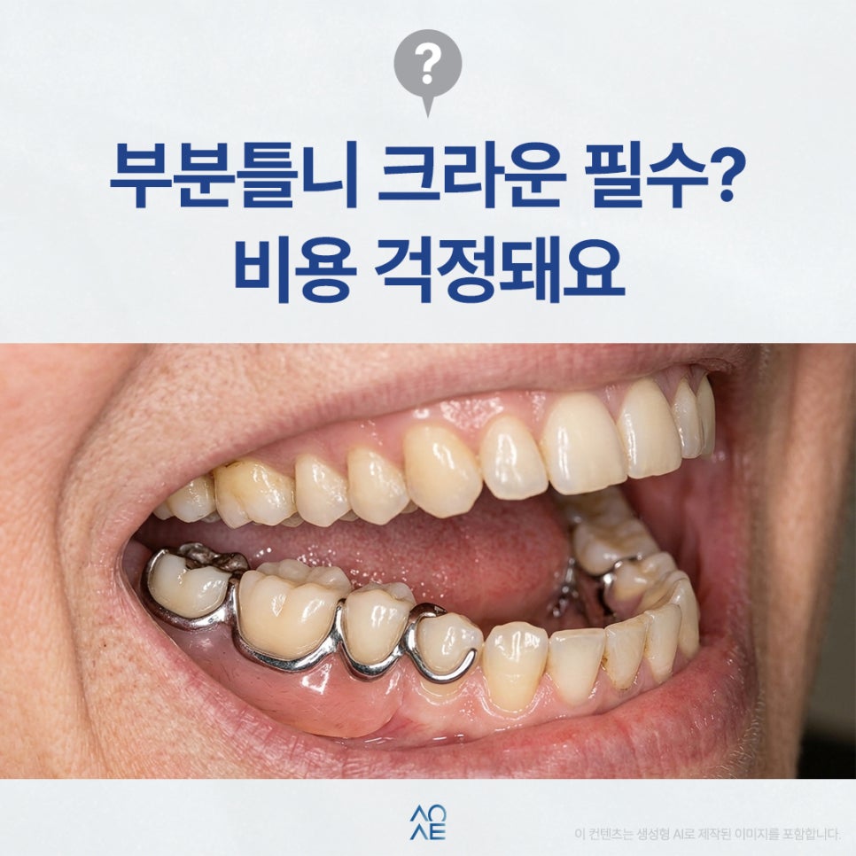 어금니 부분틀니 비용이 높다고요? 이유와 크라운 필요성 알려주세요 관련 이미지 1