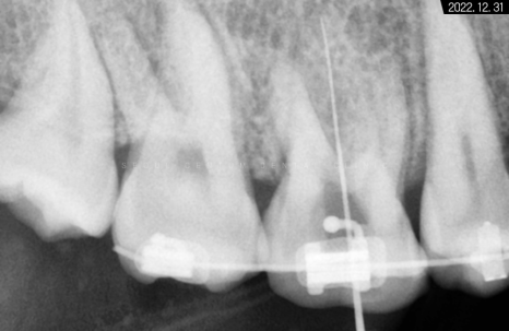 돌출입 및 신경치료와 임플란트 식립 동시 진행 증례 관련 이미지 9
