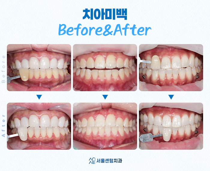 [신사역 치과] 원데이 치아미백 효과와 유지기간은 관련 이미지 7