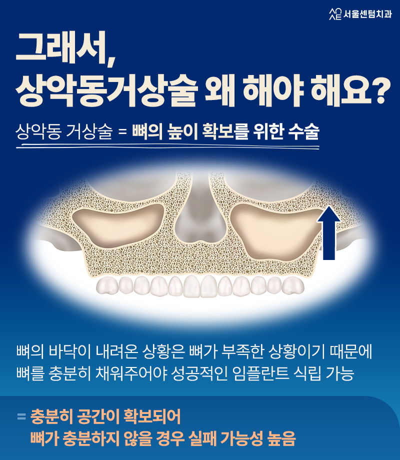 Pain After a Sinus Lift: Why Is It Suddenly Necessary When You Went to the Dentist for Implants? image 4