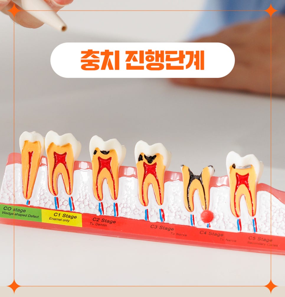 매일 양치해도 충치 생기는 이유 관련 이미지 4