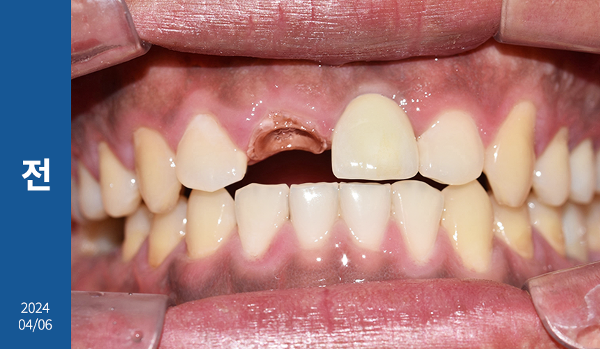 앞니 임플란트 식립으로 저작 기능을 끌어올린 증례 관련 이미지 18