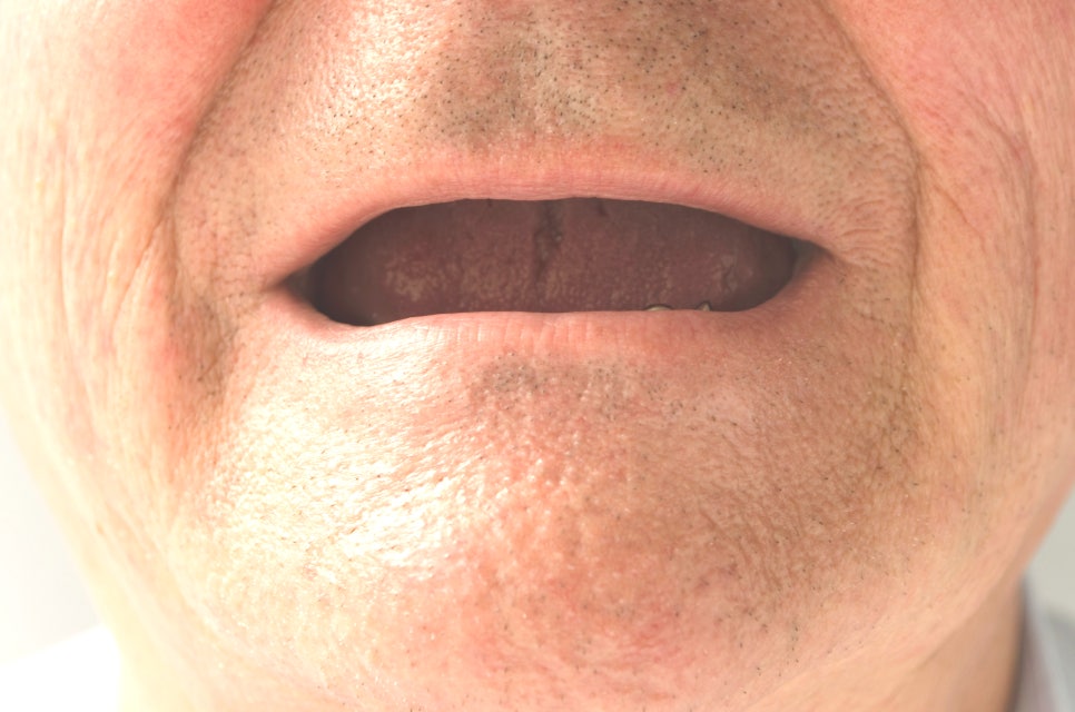 치아상실 후 잇몸으로 산다? 관련 이미지 1