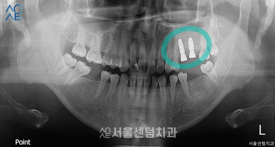 상악동수술 동반한 임플란트 진행한 이야기 관련 이미지 4