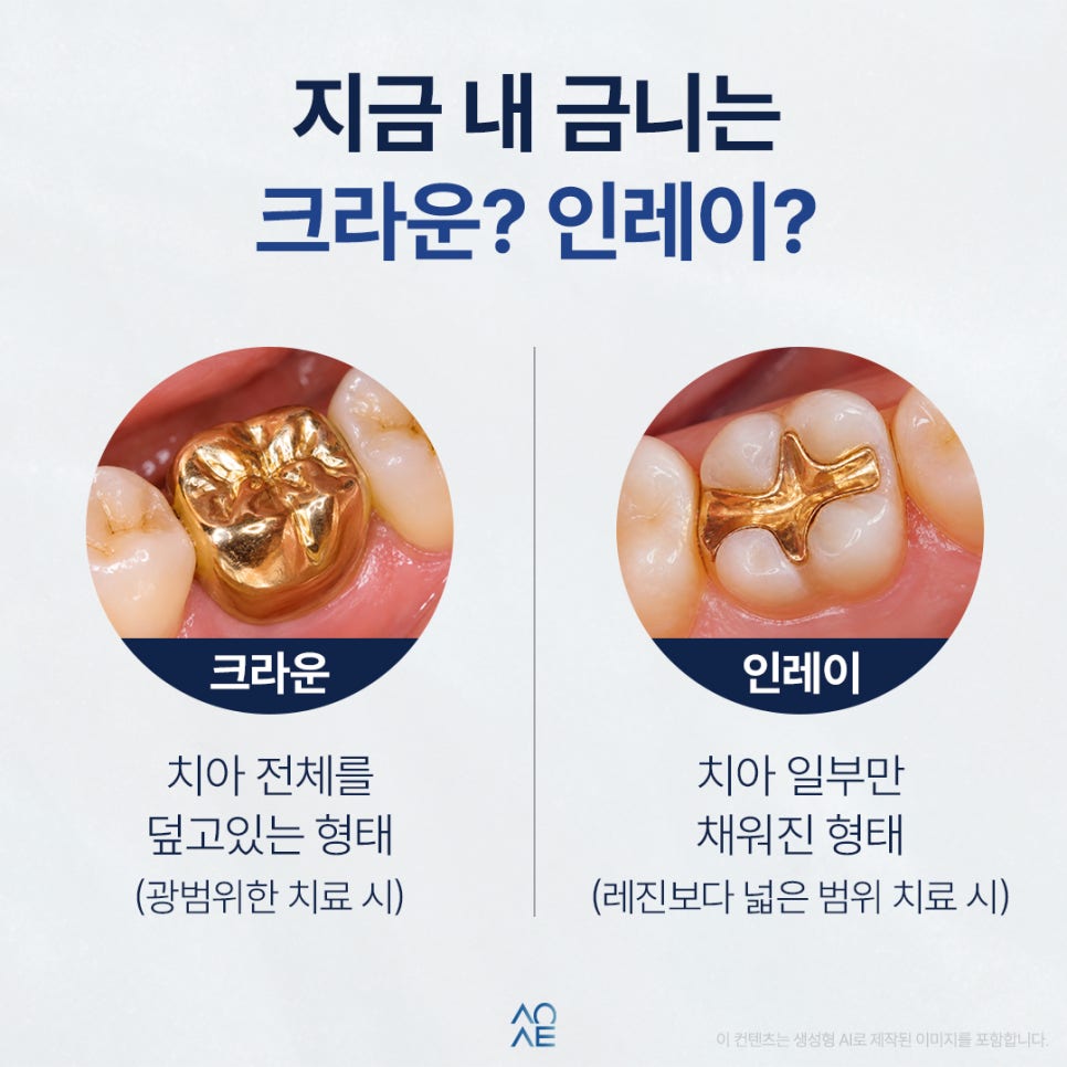 금니 판매 시세 금액 얼마나 이득볼까? 치료비도 계산해 본다면 관련 이미지 2