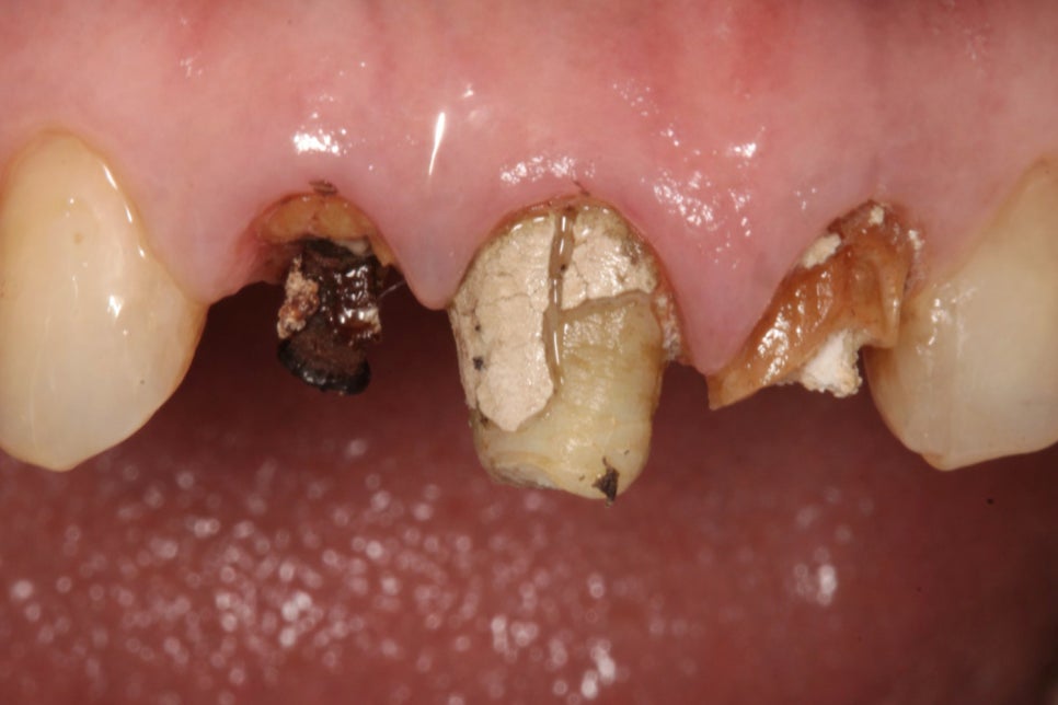 보철 밑에서 조용히 진행되는 2차 우식 - 레진 & 크라운 변연 미세누출 , 당산역 치과 관련 이미지 2