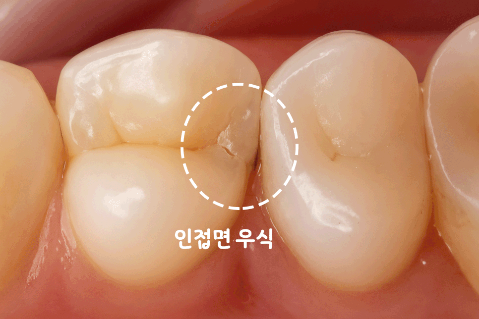 연세초록빛 치과 , 치아 진료 시 환자들이 궁금해하는 질문: 엑스레이(X-ray) 촬영은 왜 필요할까? 관련 이미지 3