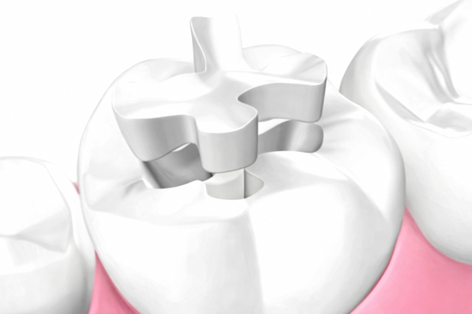 선유도역 치과 보존과 전문의가 설명하는 인레이 vs 온레이 차이점 관련 이미지 1